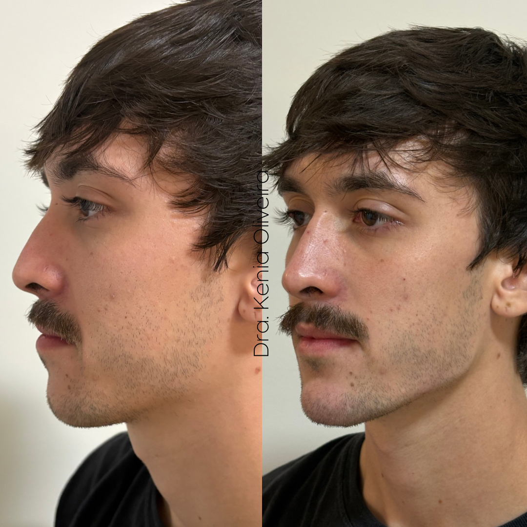 Antes e depois de harmonização facial masculina — definição de mandíbula