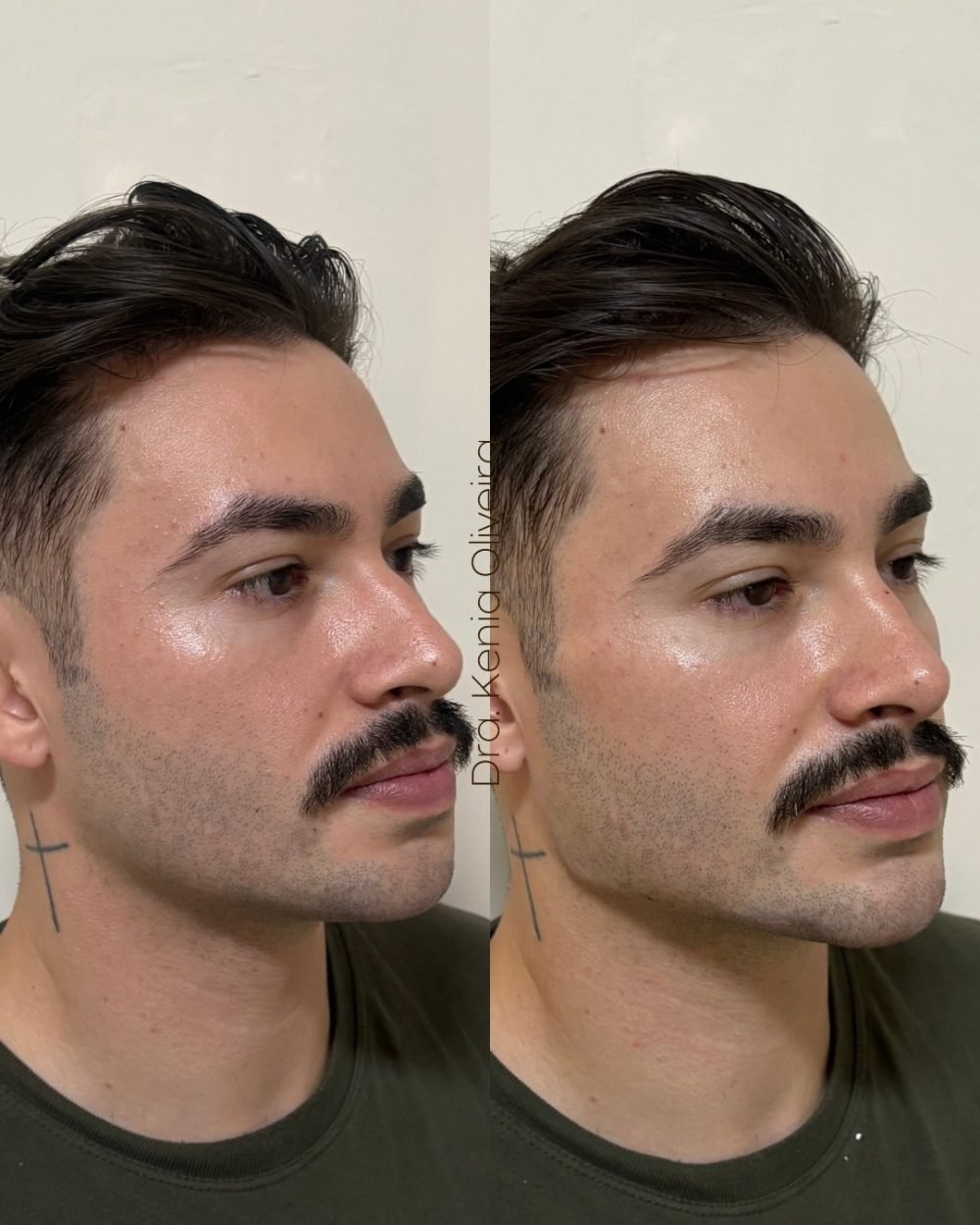 Antes e depois de harmonização facial masculina — mandíbula e queixo definidos